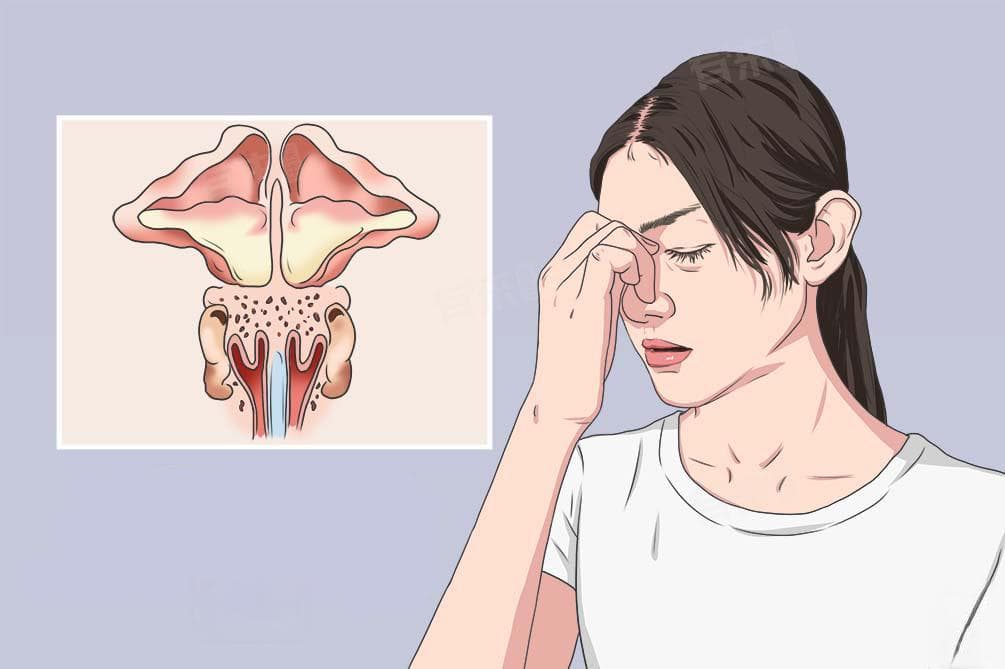 上额窦炎怎么治疗可以根除