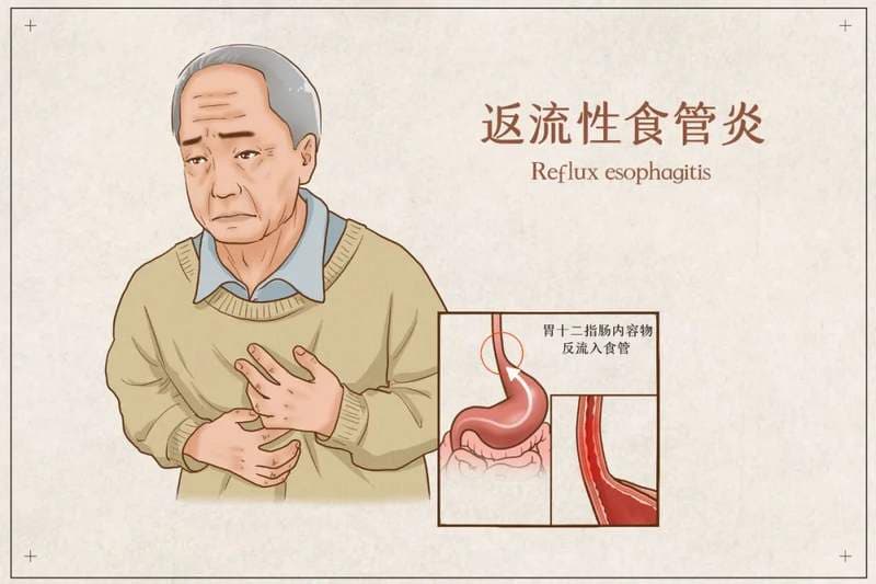 有一种生不如死，叫“反流性食管炎”，4种方法给它“治”得服服帖帖