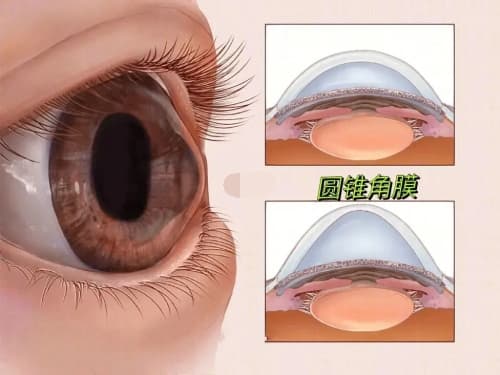 圆锥角膜近视度数发展快吗？医生明确说明圆锥角膜一定及时治疗 否则近视增成非常快！