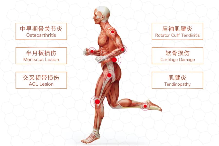 富血小板血浆PRP在运动医学运用及注意事项