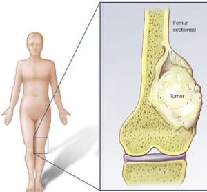 蕭醫師教您四個關鍵，鑑別為何小朋友常喊”腳痛痛”