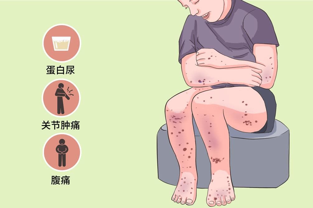 紫癜性肾炎