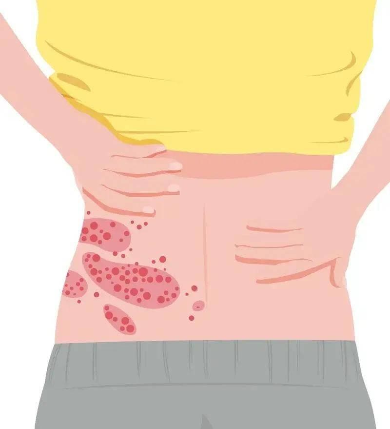 40岁以上人群，小心“蛇缠腰”！做好预防，远离4个发病因素！
