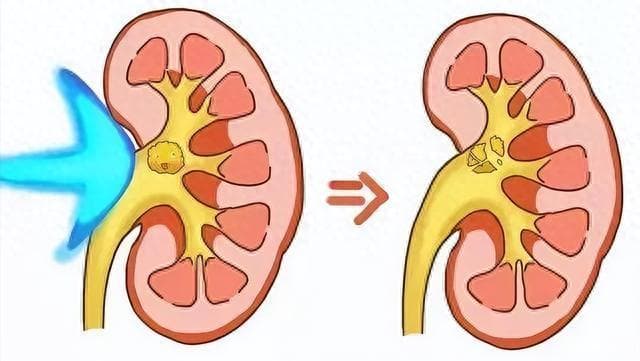 肾结石不是一下形成的！日常这些习惯都易引起结石，做好早期预防