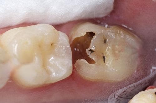 后槽牙坏了是补还是拔掉好？实力医师在线详细解答