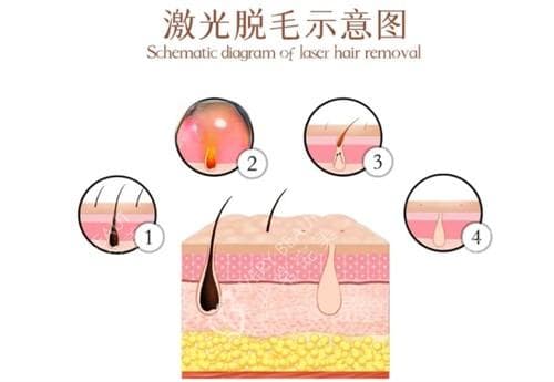 激光脱毛和冰点脱毛哪个好？分享两者特点和收费不要错过！