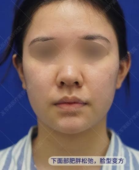 面部发腮的原因有哪些？面部发腮的解决方法攻略！