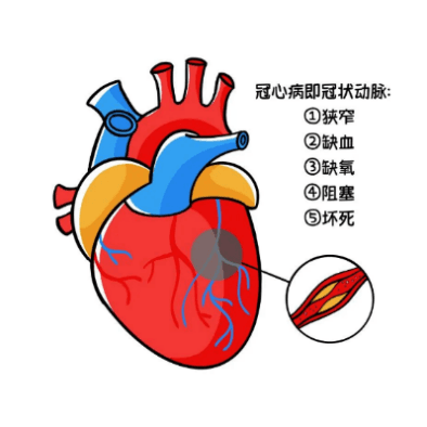冠心病的介入治疗