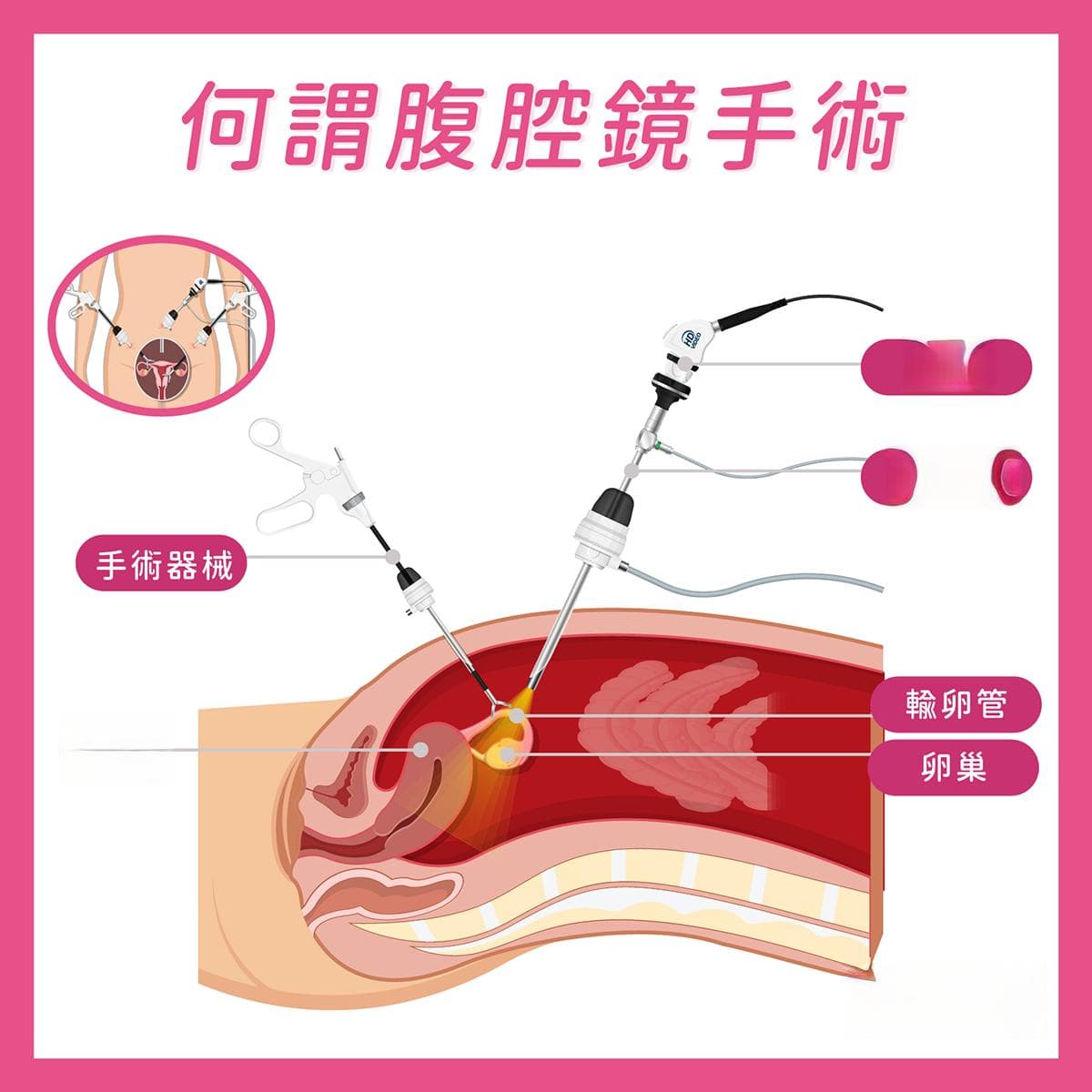 腹腔鏡手術再升級!「3d立體微創腹腔鏡手術」優點、適應症及常見問題整理