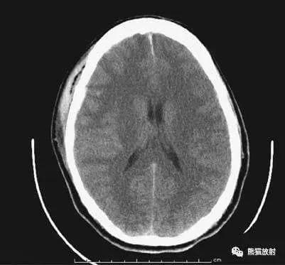 颅脑CT影像解读：正常与异常影像详解