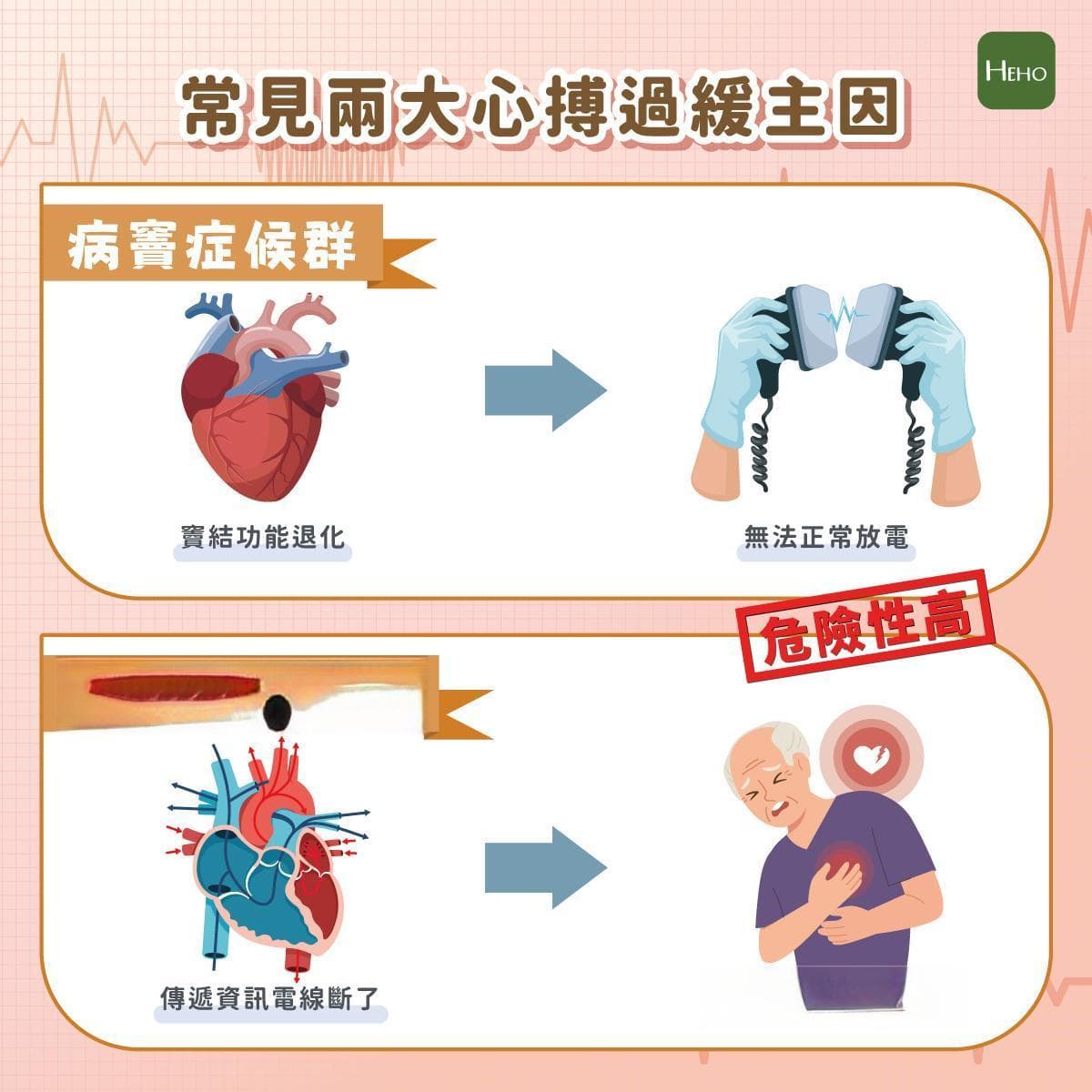 心跳过慢该怎么办？这两大状况靠心脏节律器重拾“心”生