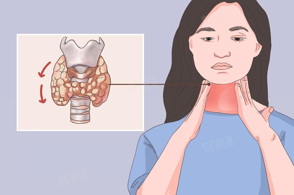 什么是甲状腺功能减退症