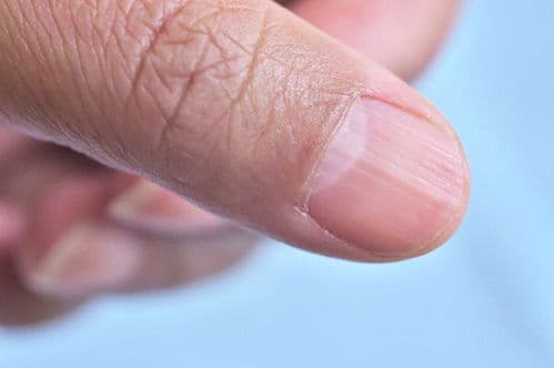 指甲出现黑线，癌症预警的信号？——科学解读与日常防范