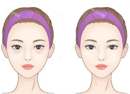 激光去眼袋 vs 手术去除：哪种方式更适合你？