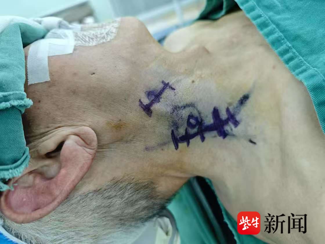 医学突破：颈深淋巴管手术为阿尔茨海默病治疗带来新希望