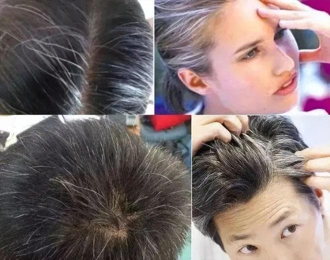 压力导致白发，但消除压力后，能解决头发白发问题吗？