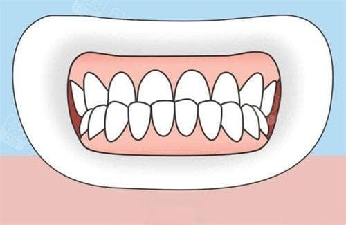 骨性反颌矫正全解析：手术是唯一选择吗？