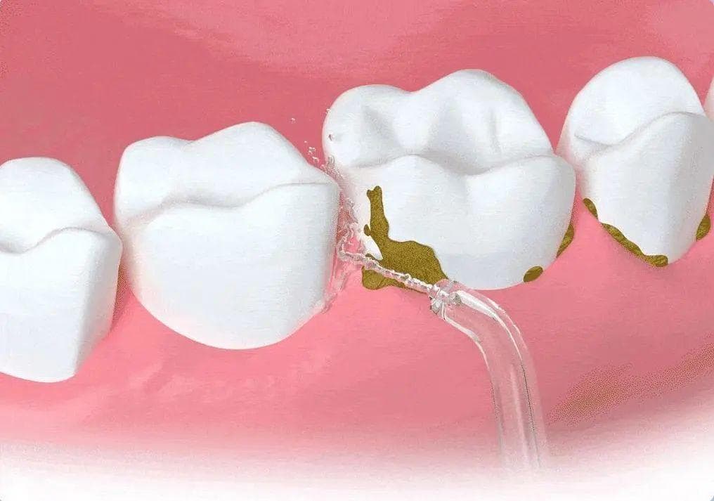 冲牙器使用全攻略：正确使用才能远离细菌、霉菌困扰