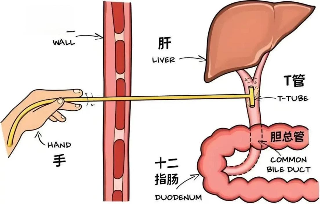 正确认识”T”管、居家护理T管，关爱带管患者