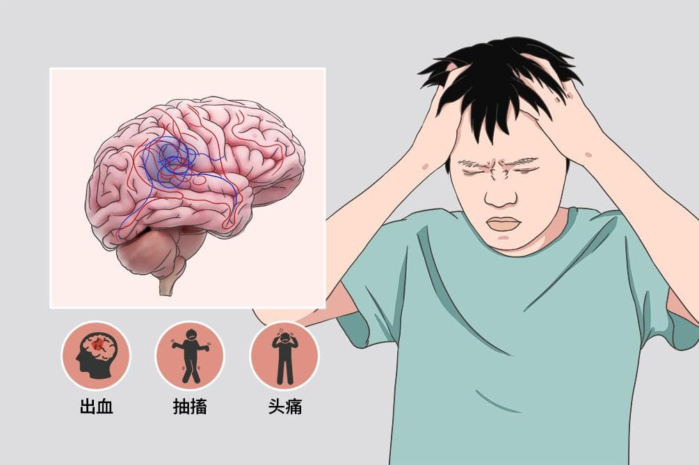 脑动静脉畸形