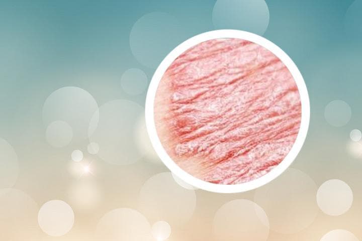 银屑病生物治疗和干细胞治疗最新进展