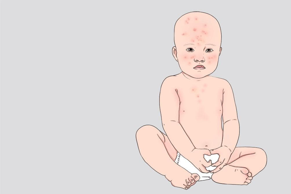 新生儿痤疮的成因、护理及预后全解析