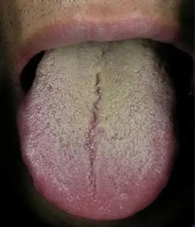 中医舌诊：痰湿、痰热、血虚、阴虚、阳虚的舌象辨别