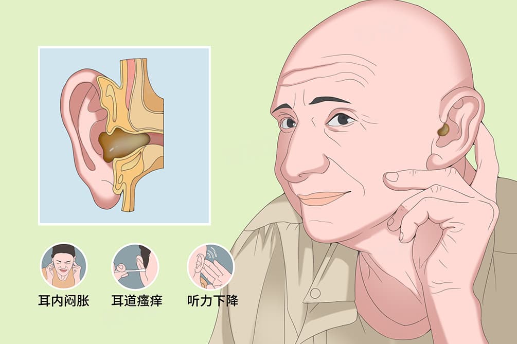 为什么会有耳屎？耵聍的形成原因与作用