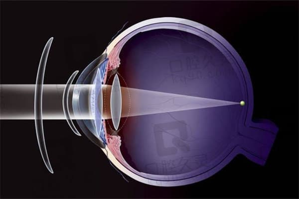 白内障分几种类型？科普白内障的分类及临床表现附治疗方法