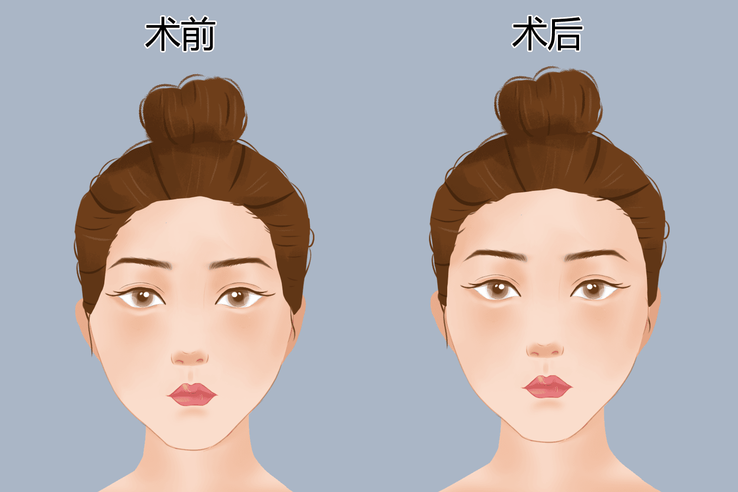 面部脂肪填充后注意事项