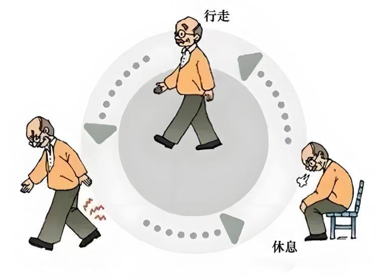 康复必看 | 从解剖到治疗，全方位了解腰椎管狭窄！