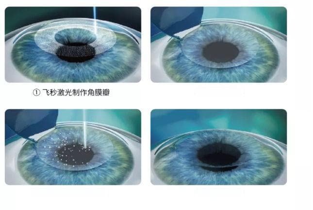 激光治近视，手术有几种？眼科专家告诉您