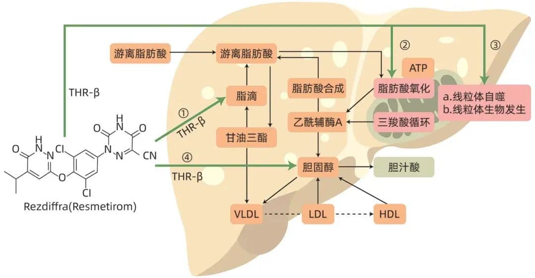 Resmetirom治疗代谢相关脂肪性肝炎的临床试验进展
