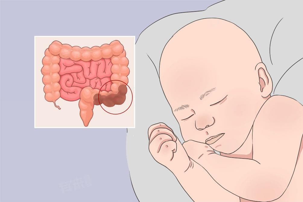 婴儿几天不拉大便怎么办