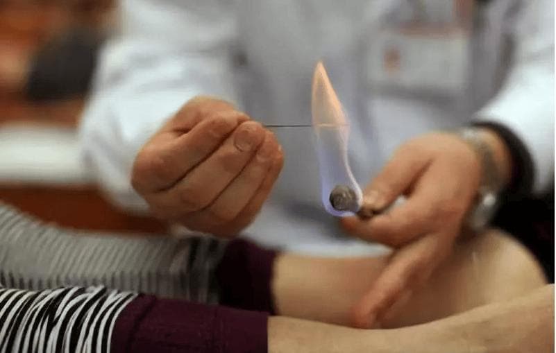 火针疗法：古老智慧，现代奇效