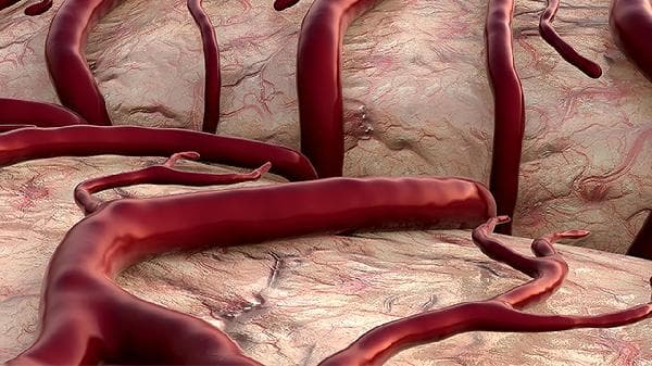 双侧肾动脉狭窄：病因、症状与防治指南