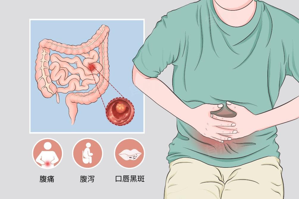 大便深褐色的原因及治疗方法