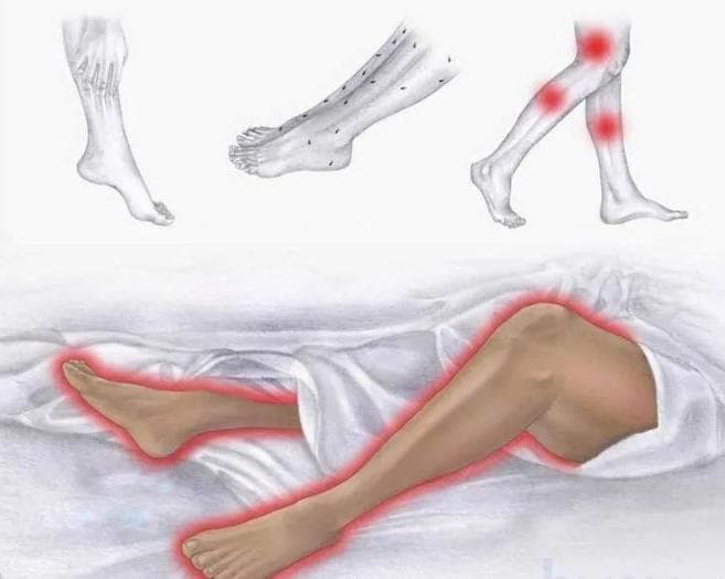 不宁腿综合征：症状识别与康复治疗指南