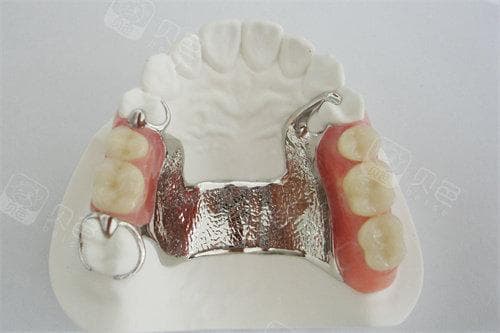 活动义齿修复牙齿缺失好不好？分析优缺点以及注意事项告知
