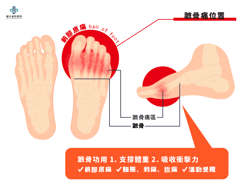 脚掌痛怎么办？蹠骨痛的原因与治疗方法