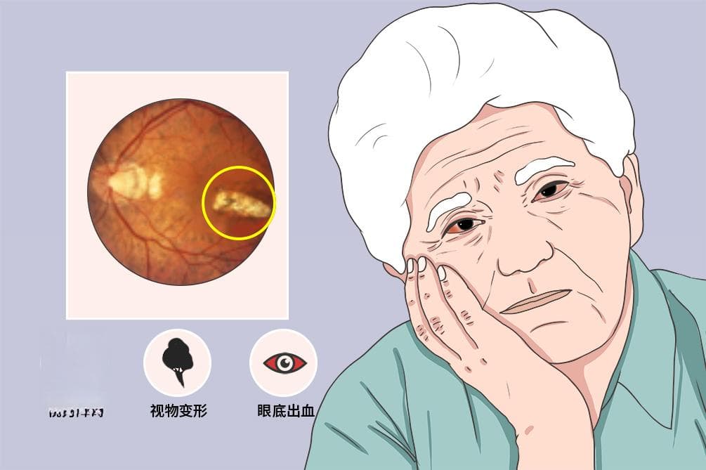 脉络膜新生血管