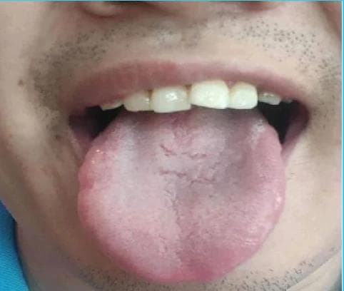 肝郁口苦，胃火口臭，出现这种舌象的人要注意了！教你1招，疏肝、健脾、清除胃火