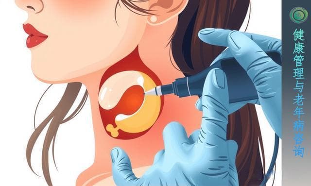 甲状腺结节查出来了，到底要不要穿刺？医生告诉你真相
