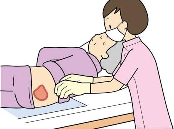 长期卧床病人褥疮防治全攻略：从成因到护理