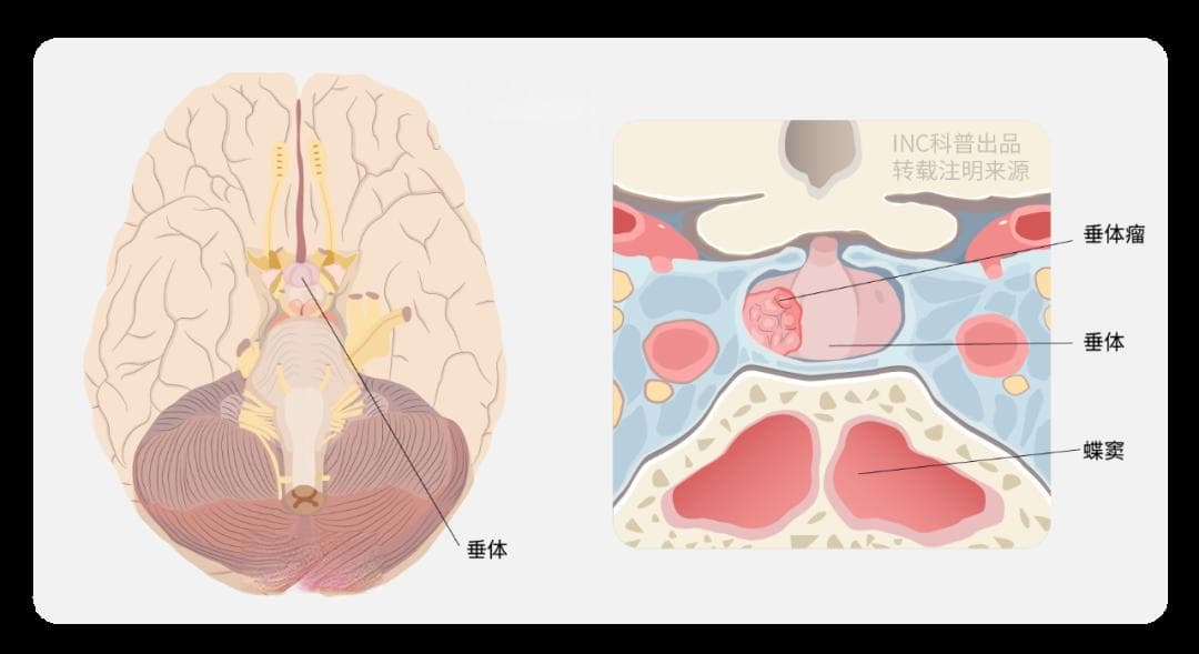 良性垂体瘤导致失明，术后一年竟复发！该再次手术吗？