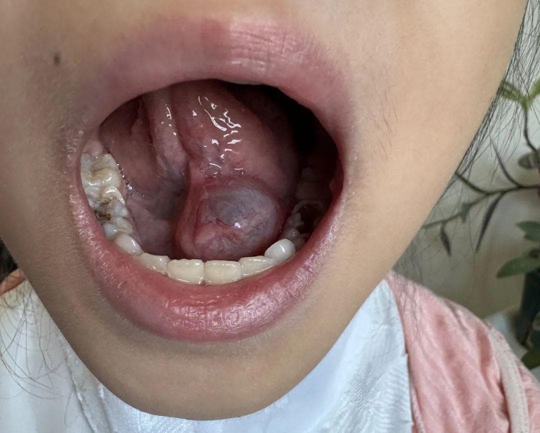 嘴巴里这种“泡泡”，千万别手痒去戳