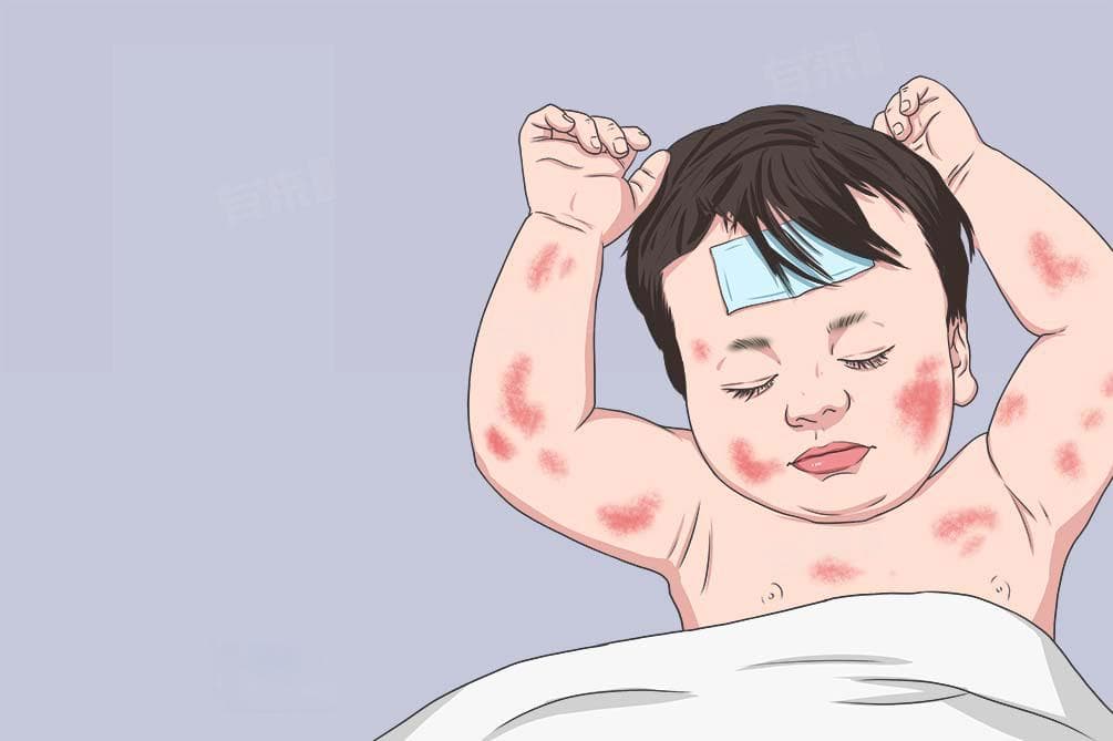 川崎病的主要临床表现及护理要点