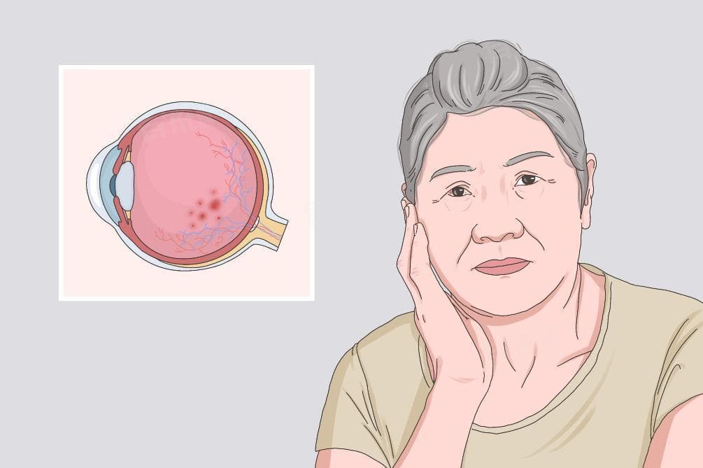 眼底出血的12种原因