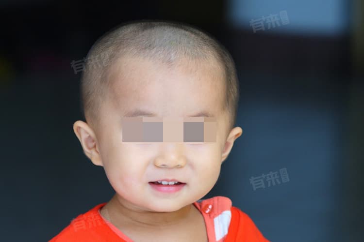 小孩摔到额头肿了个大包怎么办