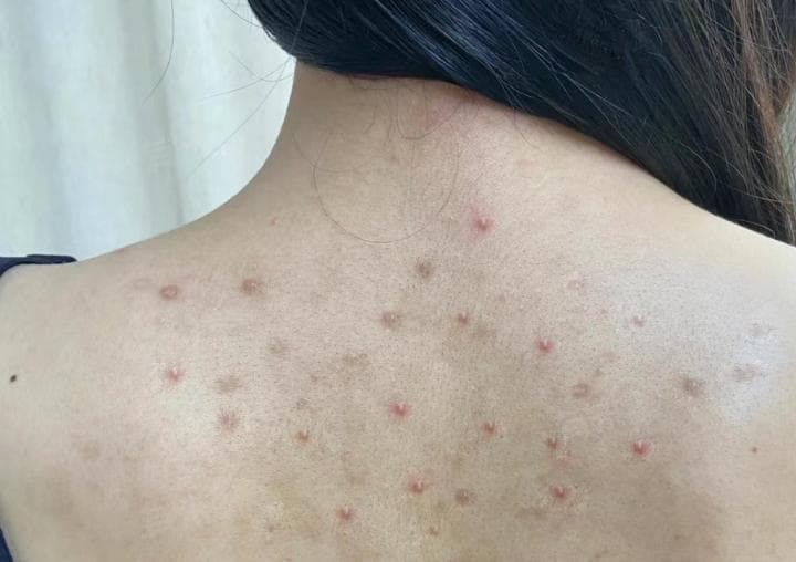 背部有痘痘怎么去除